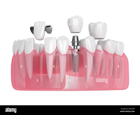 D Render Of Jaw With Dental Implants And Bridges Over White Background