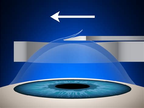 Chirurgie Lasik de l œil Turquie Istanbul Meilleurs Prix