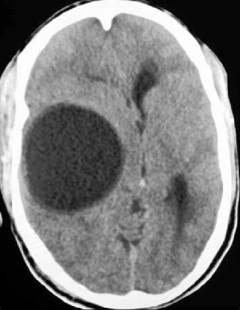 Contrast enhanced transverse CT image of brain showing a unilocular... | Download Scientific Diagram