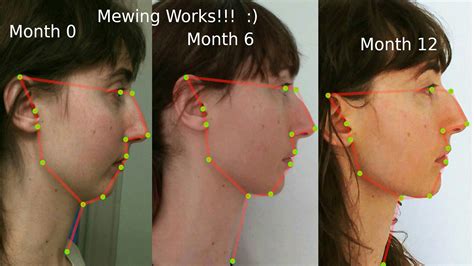 Mewing Tongue Posture Diagram Propper Mewing Tongue Posture