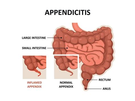 Appendicitis - 88Guru 
