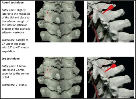 Techniques For Pedicle Screw Placement On C7 Lm Lateral Mass Download Scientific Diagram