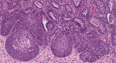 Adenocarcinoma In Situ Of The Cervix Ottawa Atlas Of Pathology