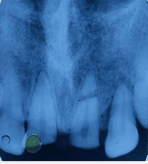 Preoperative Radiograph Showing Horizontal Root Fracture At The Download Scientific Diagram