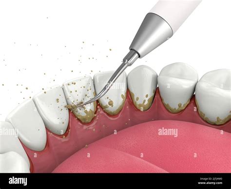 Removing Tartar And Plaque From Teeth By Ultrasonic Scaler Dental