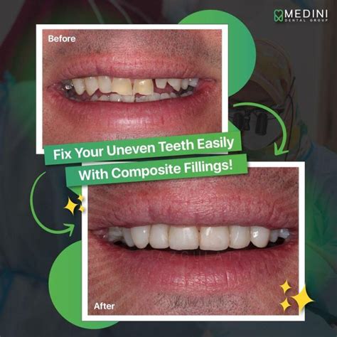Tooth Filling Procedure: A Step-by-Step Guide