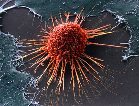 Cervical Cancer Cell Sem Stock Image M Science Photo Library