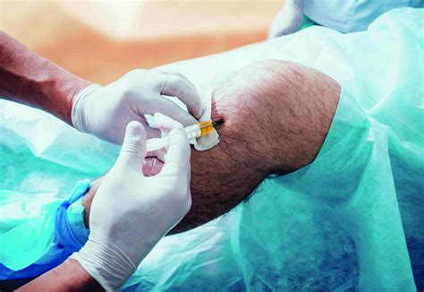 Tout Savoir Sur Les Injections De Prp