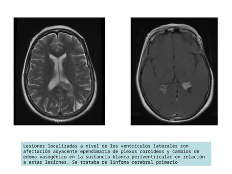 PPT Lesiones localizadas a nivel de los ventrículos laterales con