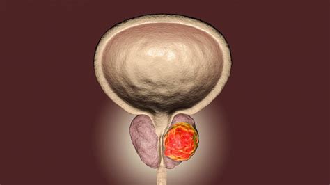 Stages Of Prostate Cancer