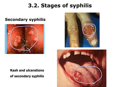 Syphilis Serology Serological Test For Medical Laboratory Ppt