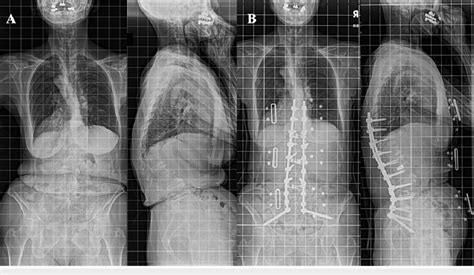 Pre And Postoperative Standing Position Posterior To Anterior And