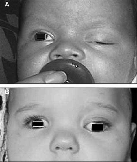 Figure From Stability Of Silicone Band Frontalis Suspension For The