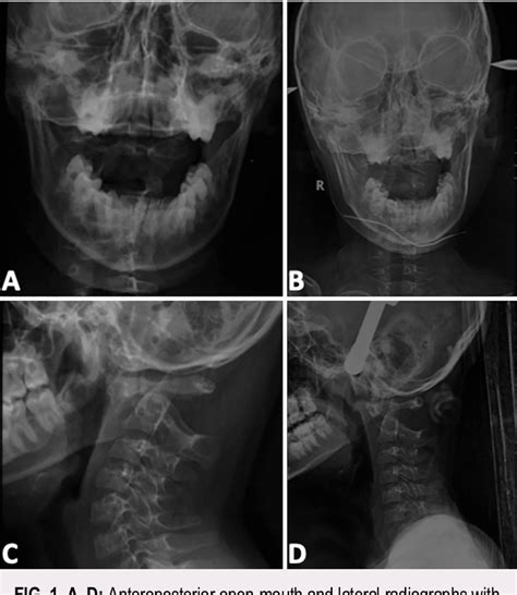 Figure From An Unusual Injury Mechanism Of Atlantoaxial Dislocation