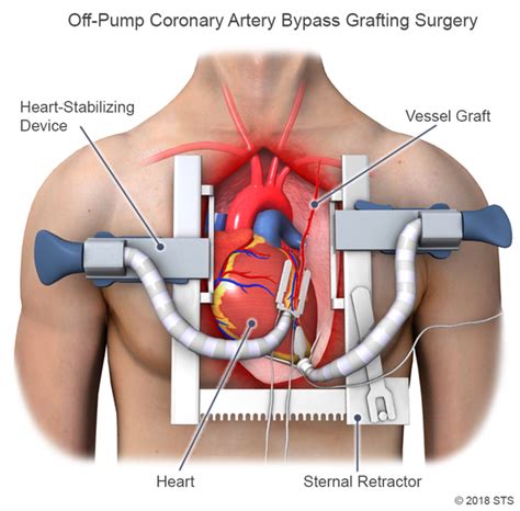 MICS CABG Minimally Invasive Coronary Bypass