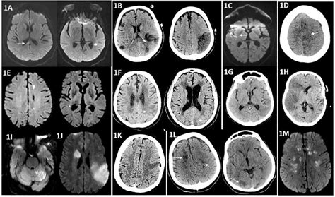 (A-M) Imaging characteristics of ischemic stroke in COVID-19 patients ...