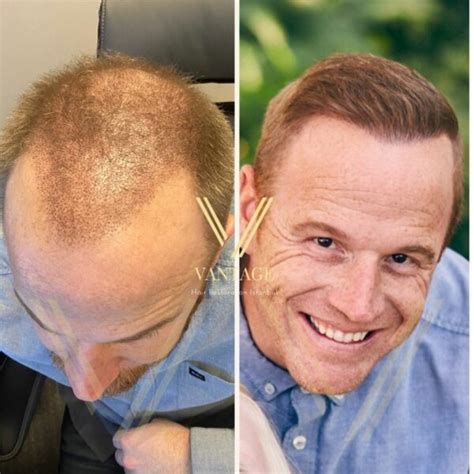 7000 Grafts Hair Transplant In Turkey 2023 Costs Vantage Clinic