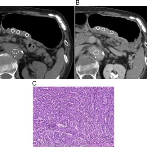 The Case Of An 82 Yearold Woman With Moderately Differentiated Download Scientific Diagram