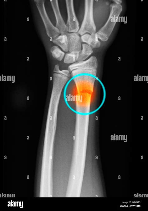 Fractura Radio Distal Fotografías E Imágenes De Alta Resolución Alamy