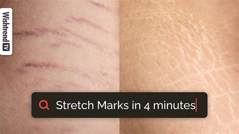 How To Get Rid Of Stretch Marks Ingredients That Work For Stretch