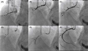 Coronary Angiography Cost - ThePricer Media