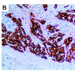 | Pathologic findings of this patient. (A), Bronchoscopic biopsy of the ...