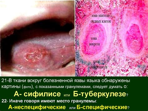 Хроническое (пролиферативное) воспаление - презентация онлайн