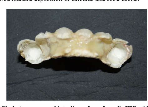 Figure 1 From Management Of Pontic Induced Reactive Hyperplastic