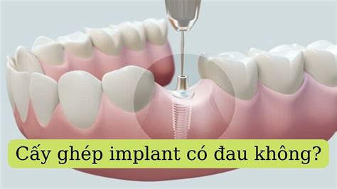 C M Implant C Au Kh Ng I U B N C N Bi T Khi C Y Gh P Implant