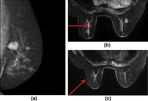 Mri Guided Breast Biopsy A Review Of Technique Indications And