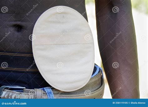 African Person With A Colostomy Bag Health Care Stock Image Image Of