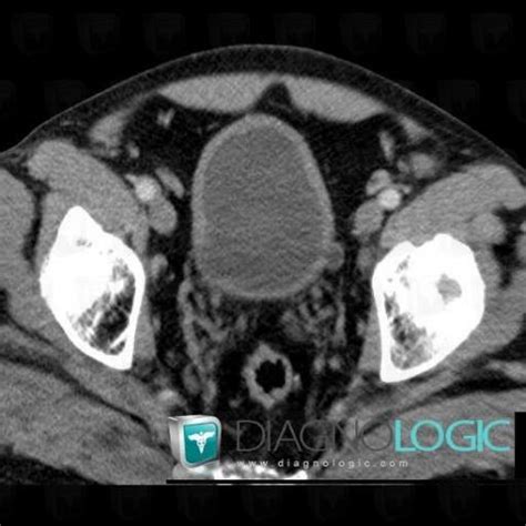 Cas Radiologie Diverticule De Vessie Echographie Scanner Diagnologic