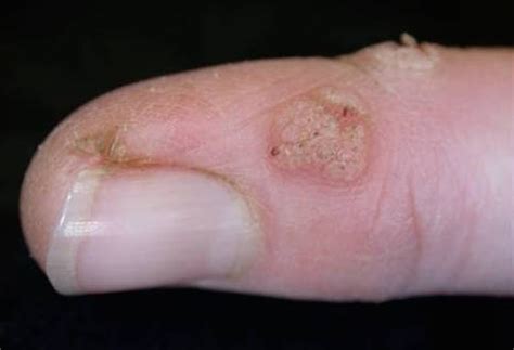 Health Check: do home remedies for common warts really work?