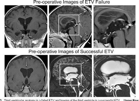 Figure 1 From Preoperative Third Ventricular Bowing As A Predictor Of Endoscopic Third