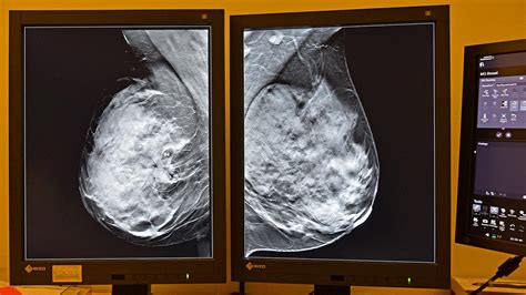 Artificial Intelligence Enhances Breast Cancer Screening