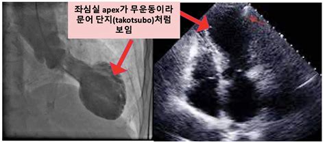 스트레스 유발 심근병증 Takotsubo Cardiomyopathy 메디톡