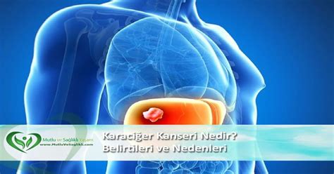 Karaciğer Kanseri Nedir Karaciğer Kanseri Belirtileri ve Nedenleri