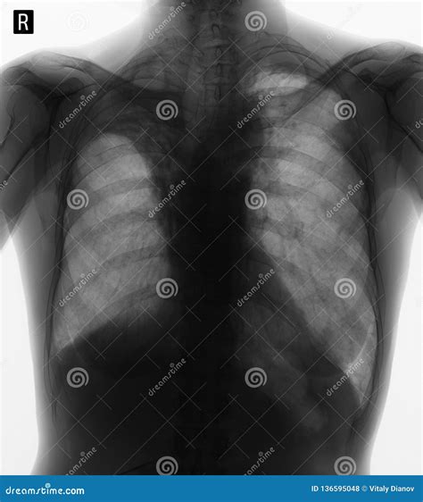 X Ray Of The Lungs Hemothorax Rib Fractures Of The Left Negative