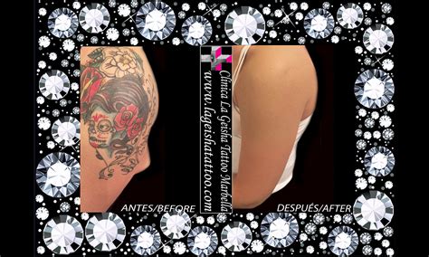 Quick And Effective Tattoo Removal Of Skulls And Roses In Full Color