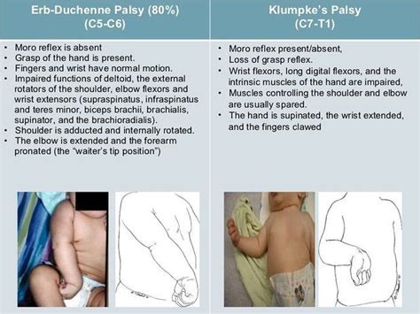 NPTE StudyBuddy On Instagram Erb S Palsy And Klumpke S Palsy