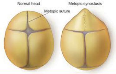 Metopic Craniosynostosis - BBY LUV