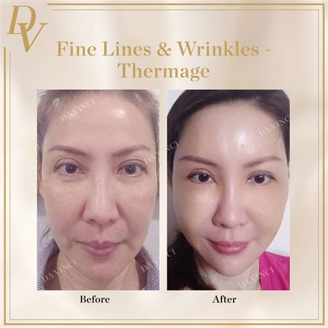 Fine Lines & Wrinkles - Da Vinci Clinic