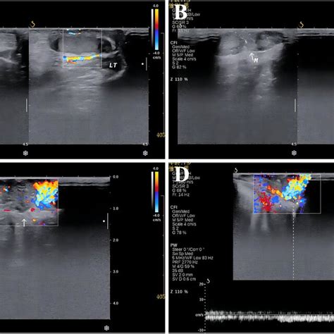 Preoperative Colour Doppler Ultrasonography A Bilateral Testicular