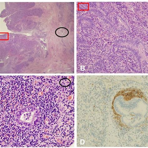 A Dilated Fallopian Tubes Revealed Marked Mucosal Hyperplasia Under Low