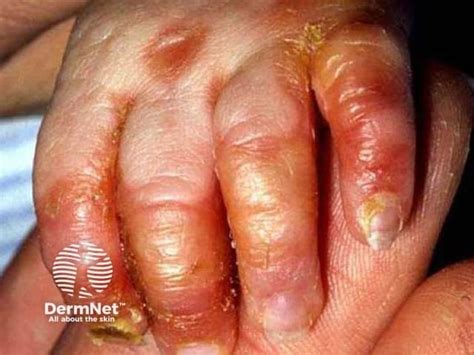 Zinc Deficiency Acrodermatitis Enteropathica