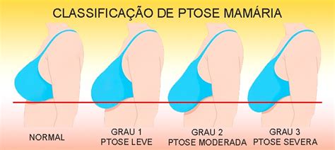 Cirurgia plástica mamoplastia redutora Dr Thiago Calado