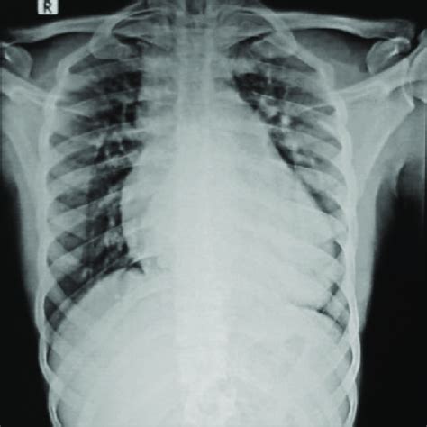 Chest Radiograph Revealed Cardiomegaly With Mediastinal Widening