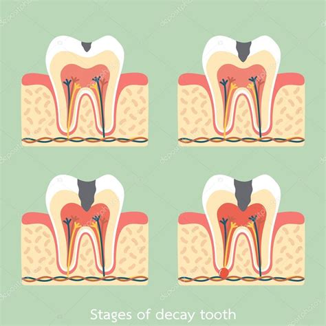 Etapas De La Caries Estructura De La Anatomía Dental Incluyendo El