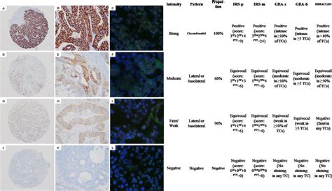 Her2 Evaluation Using Five Immunohistochemistry Ihc Assessment