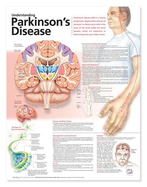 Understanding Parkinsons Disease Poster Parkinsons Anatomical Chart Company